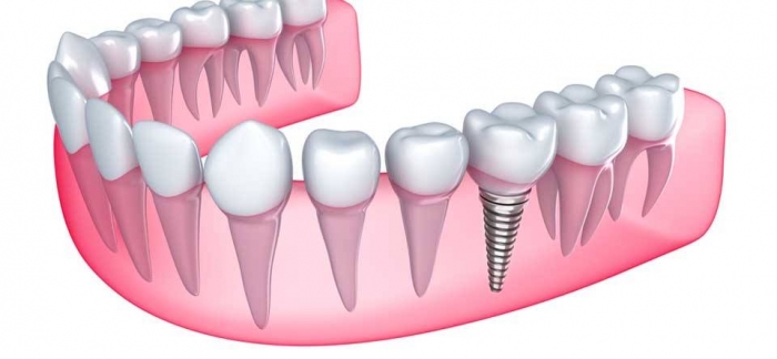 استعيد اسنانك المفقودة مع اخصائى زراعة الاسنان