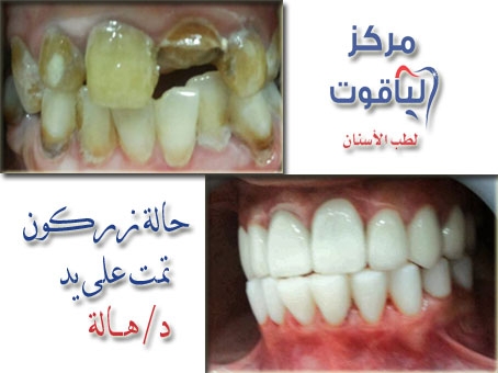 اسنان مركز الياقوت لطب الاسنان